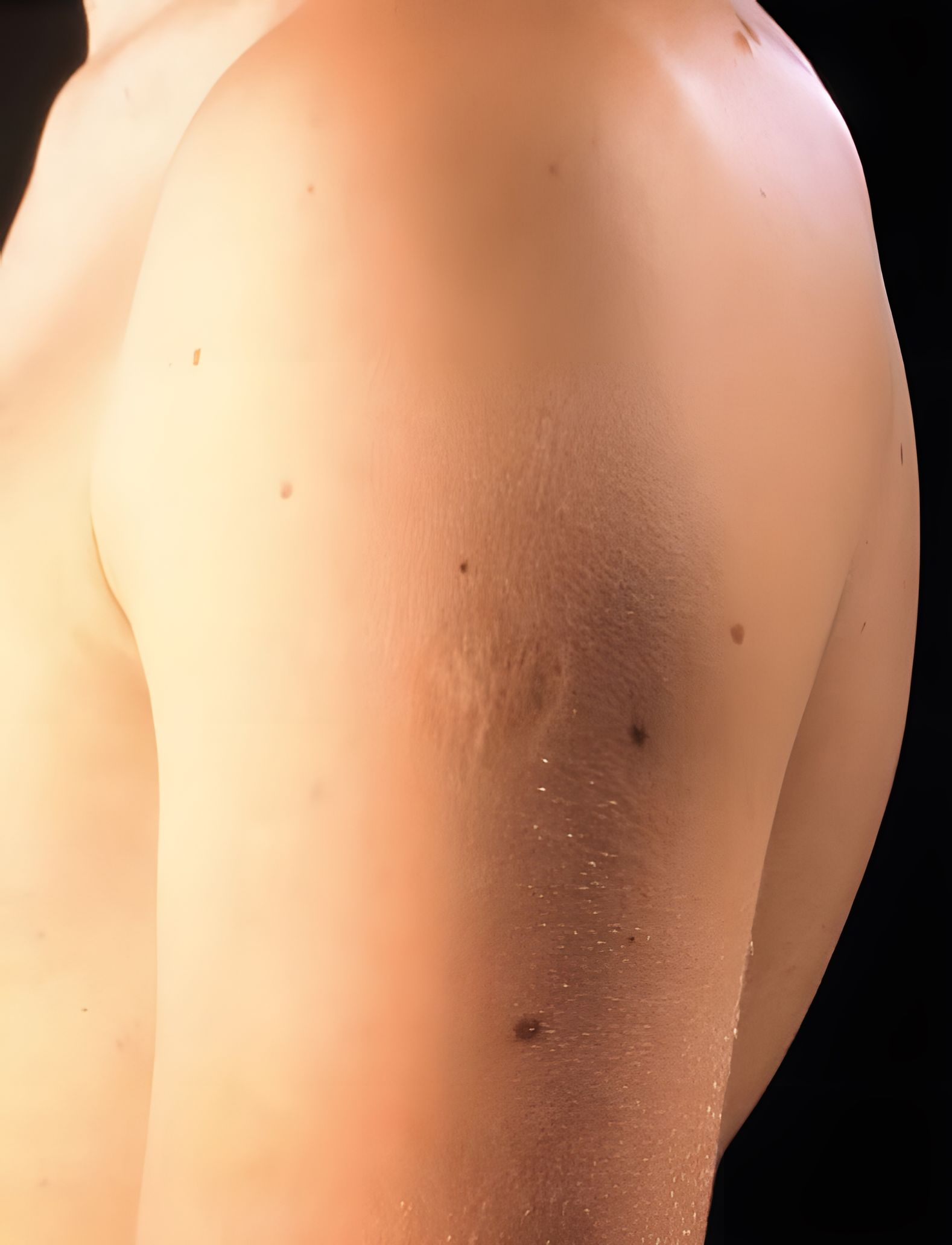 Smallpox vaccine scars: What they look like and why Smallpox vaccine scars: What they look like and why